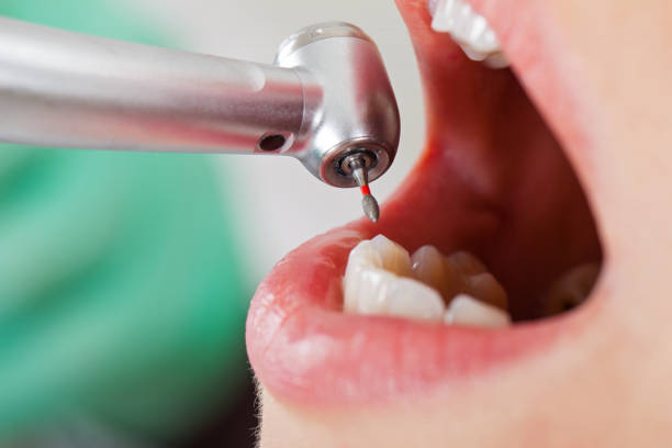 Best Broken or Chipped Tooth Repair in USA